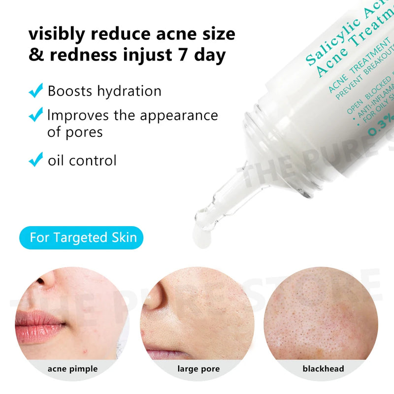 Crema facial con ácido salicílico para el acné