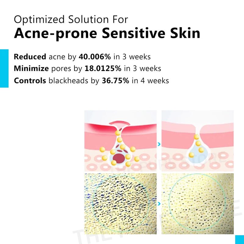 Crema facial con ácido salicílico para el acné