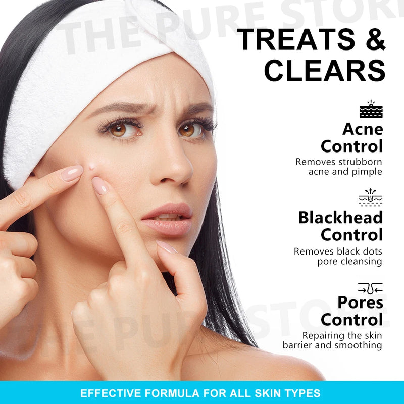 Crema facial con ácido salicílico para el acné